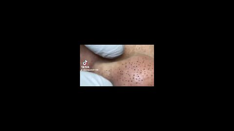 Insane Blackheads Ozzing out!