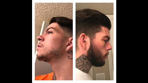 SUCCESSFUL BEARD ROGAINE (MINOXIDIL) 4 MONTH EXPERIMENT