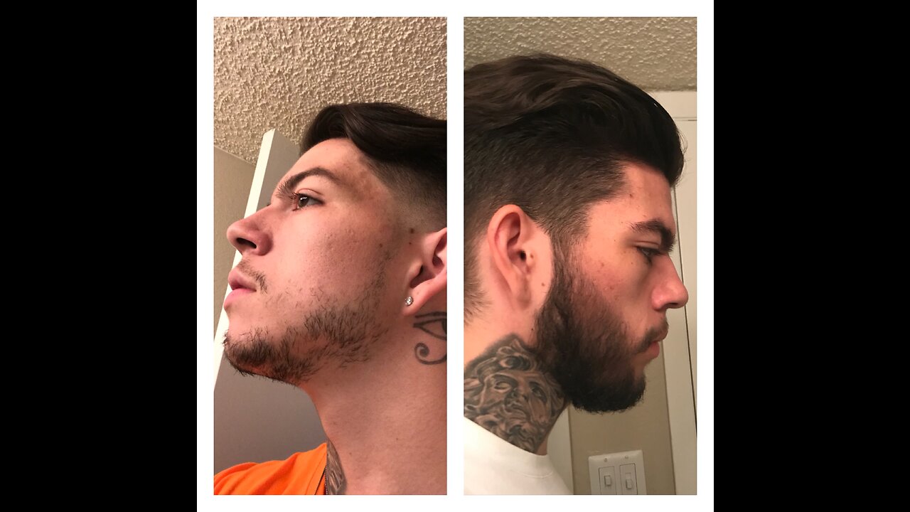 SUCCESSFUL BEARD ROGAINE (MINOXIDIL) 4 MONTH EXPERIMENT