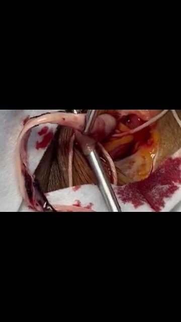mRNA Clots - Video by Richard Hirschman - Funeral Director and Embalmer 💉(2024)