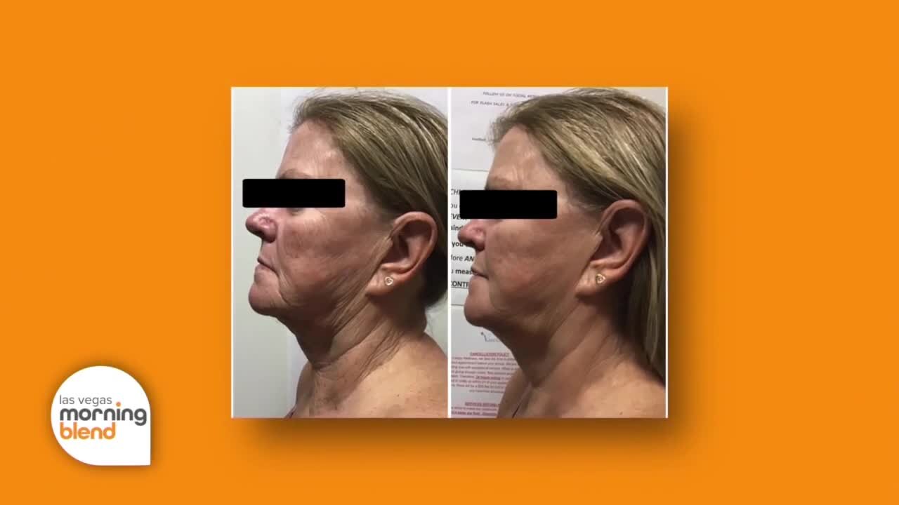 Look 10 Years Younger In 60 Minutes With Non-Surgical Face Lift