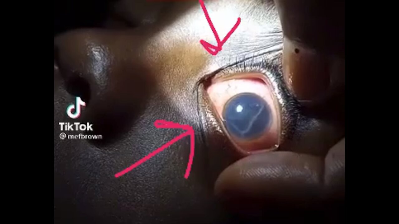 Living creature in this person’s eye