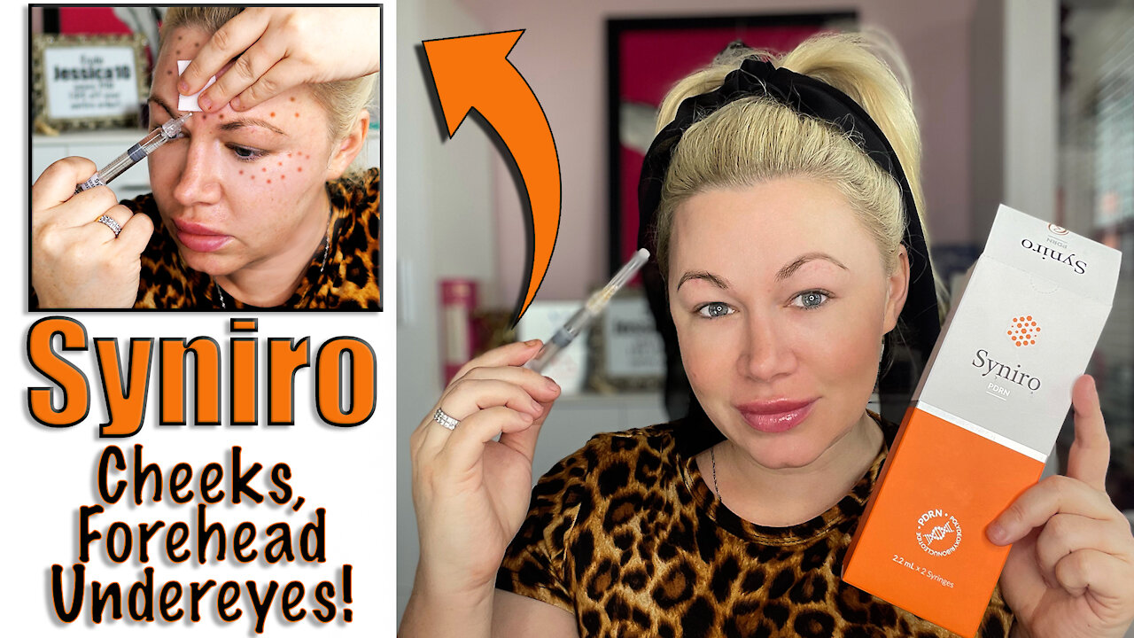 Syniro PDRN Meso Therapy in Cheeks Forehead and Undereyes | Code Jessica10 Saves you $$$$