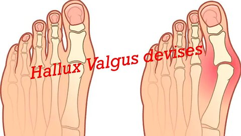 Hallux valgus devises- cheap, but helps.