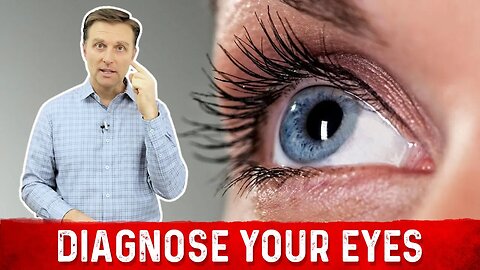 Nutritional Deficiency Symptoms From Eyes – Dr. Berg