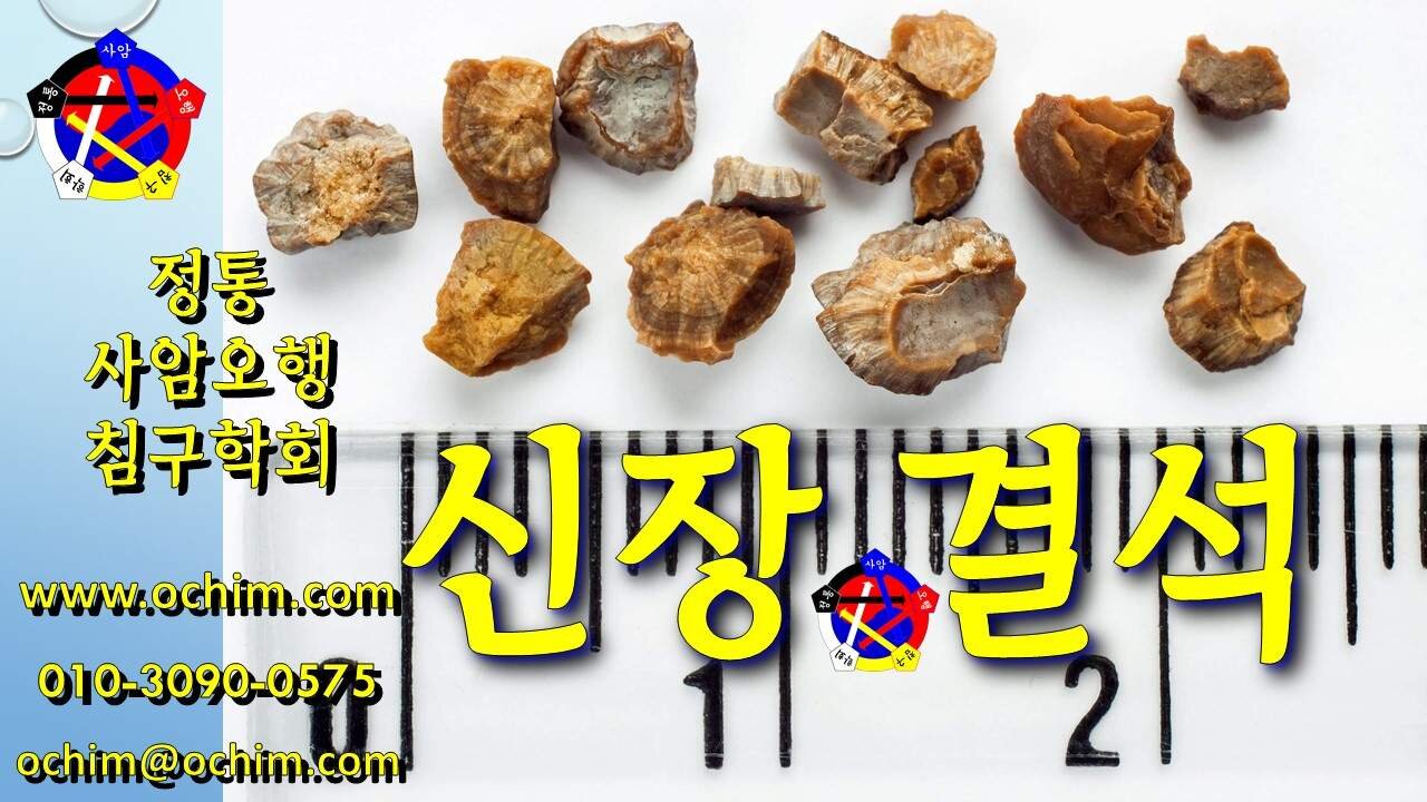 신장 결석 치료 방법 및 사례 - 비과학적 양의학 207 - 사암침, 사암침법, 정통사암침