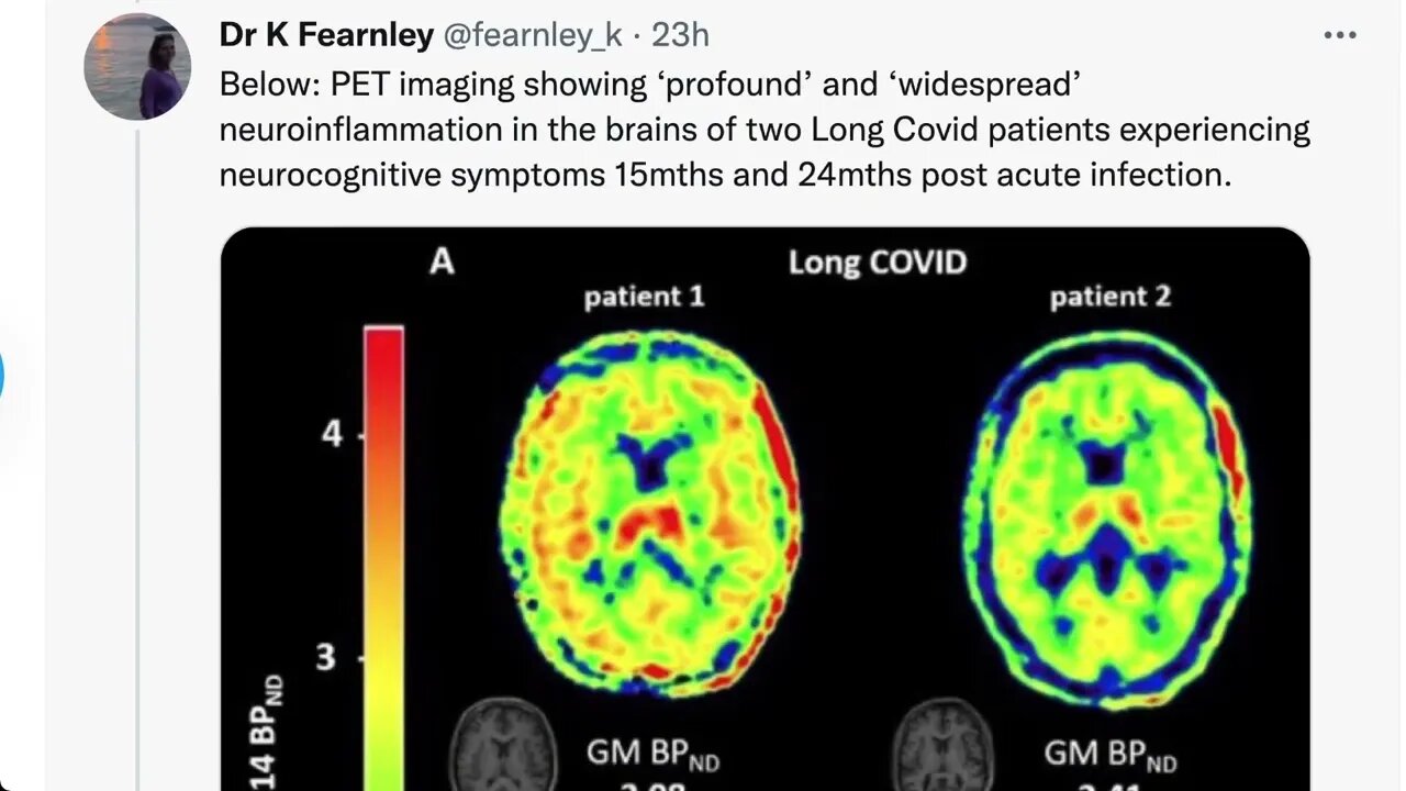 新冠後遺症 + 在辦公室感染新冠，是否「工傷」