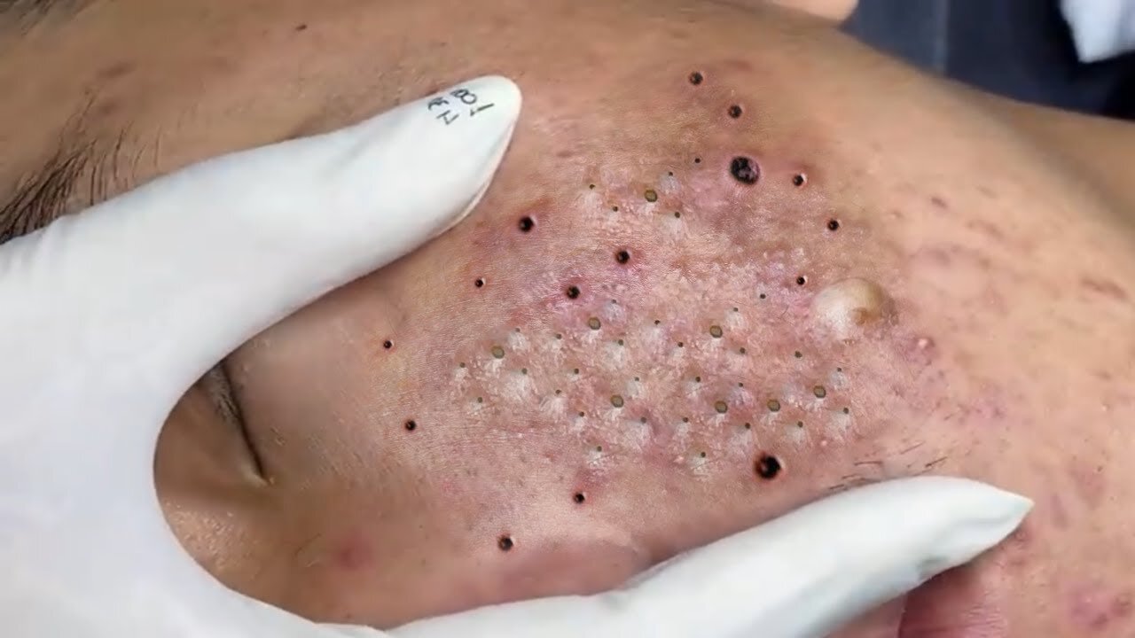 blackhead acen pimple removing