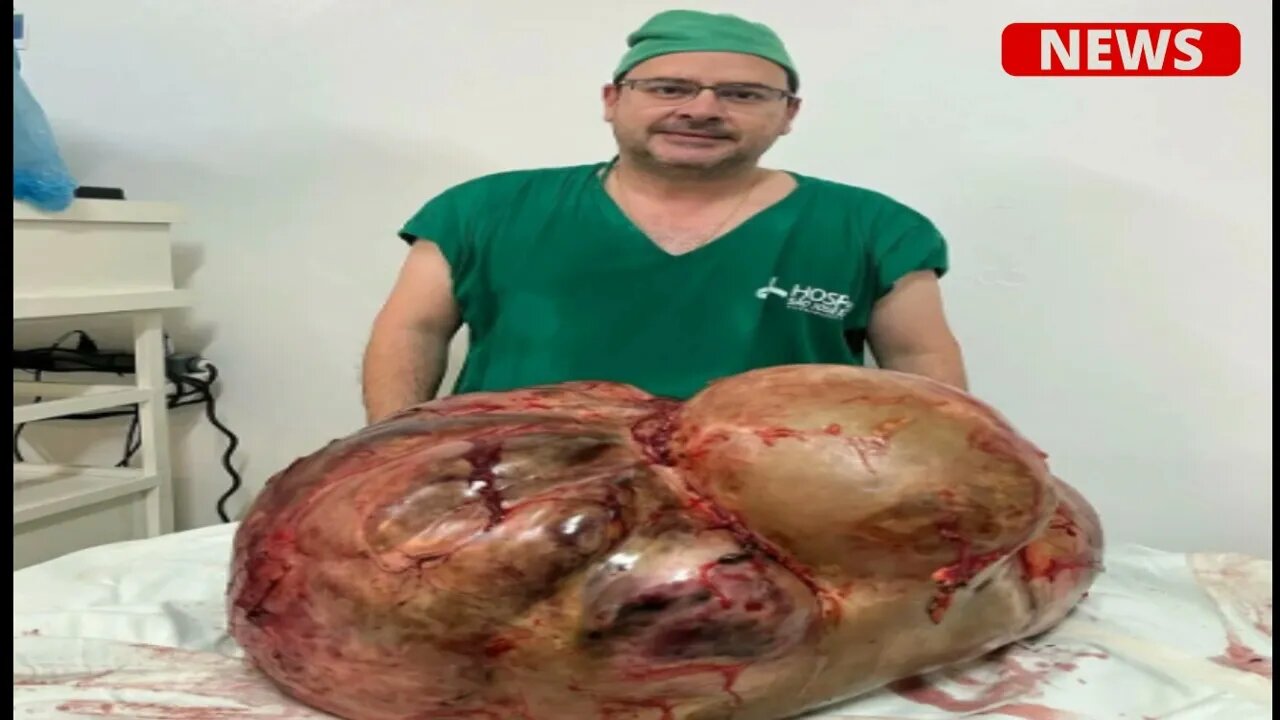 Tumor de 46 kg retirado em cirurgia de emergência