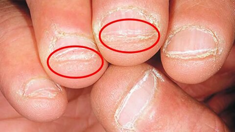 Como parar de Roer as Unhas de Uma Vez Por Todas