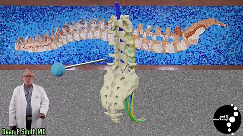 InterSpinous Devices