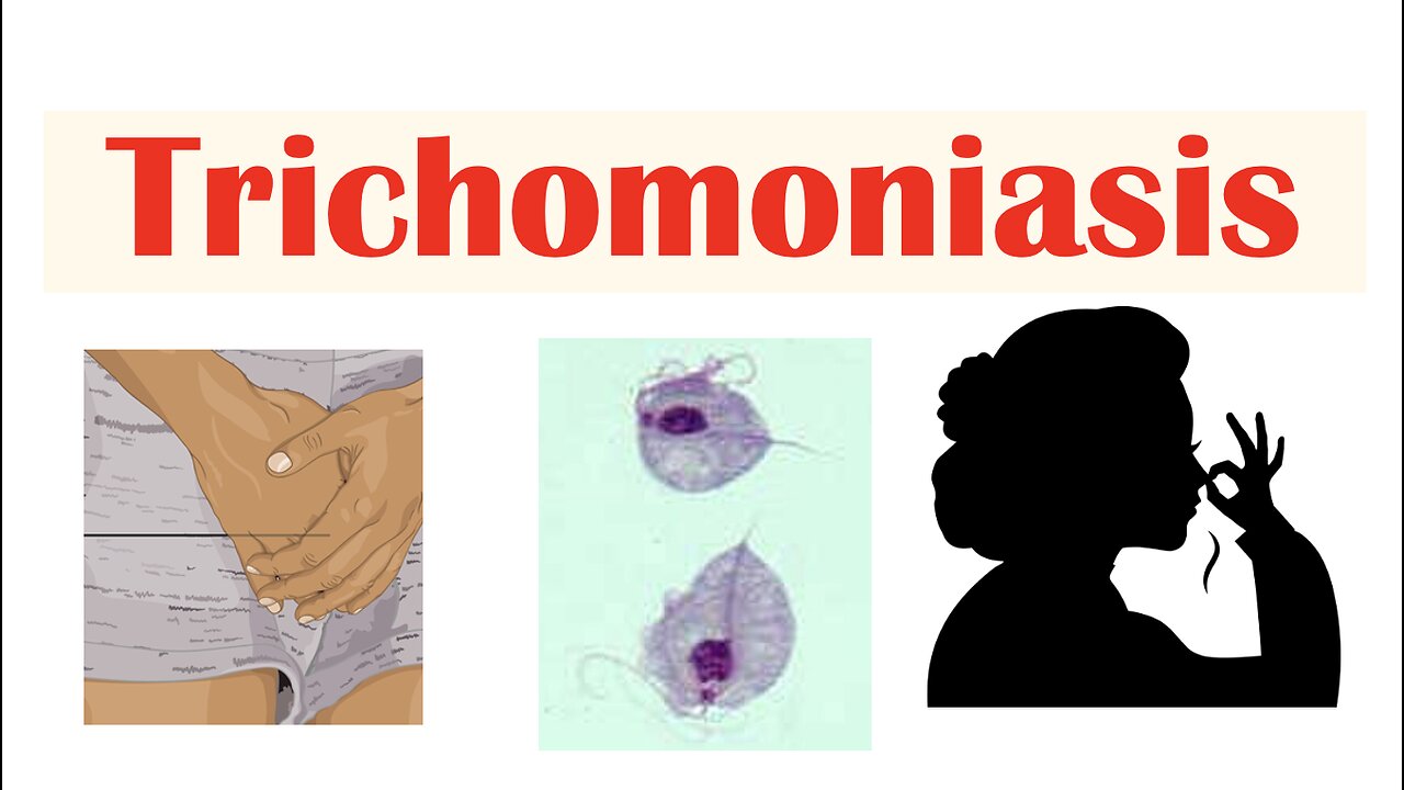 Trichomoniasis (Common STI) | Causes, Symptoms & Complications (Cancer), Diagnosis, Treatment