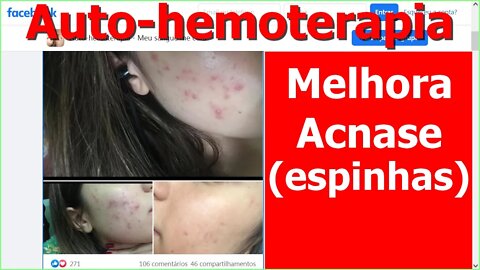 Auto-hemoterapia melhora acnase (espinhas no rosto). Relato de Caso Documentado.