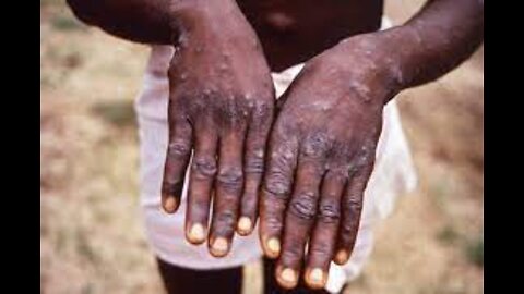 Growing Monkeypox Outbreak l WNT