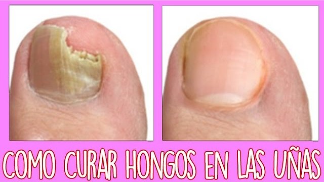 Hongos en las uñas delos pies