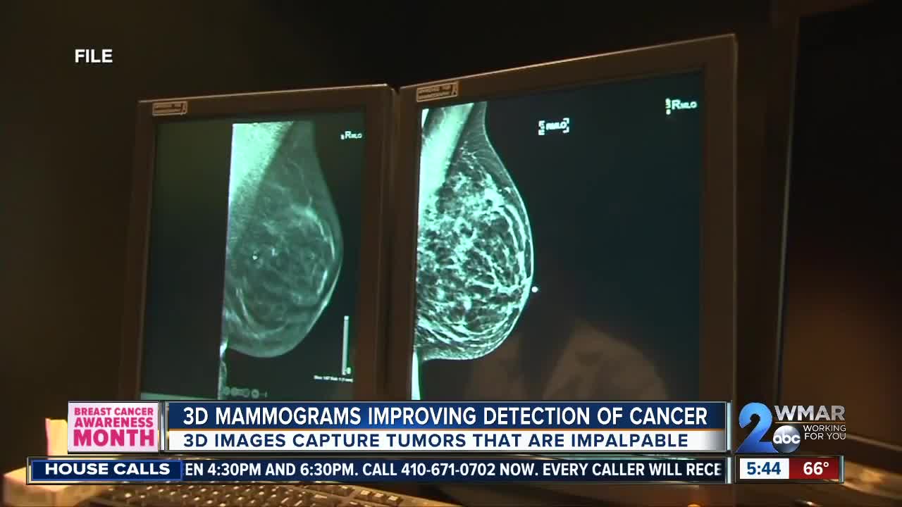 3D Mammogram detects local woman's stage 1 breast cancer