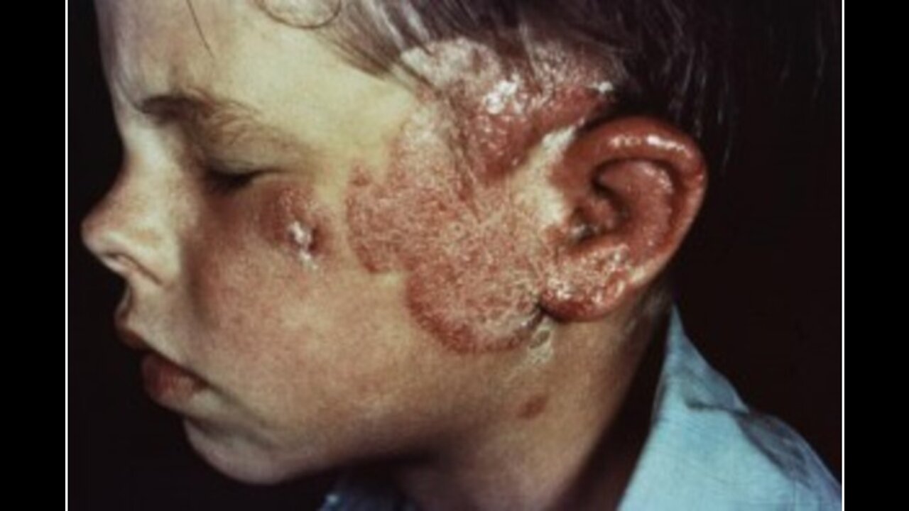 The Ringworm Children: A Jewish Genocide