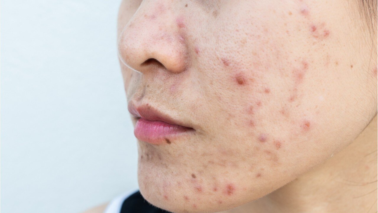 What Causes Acne?