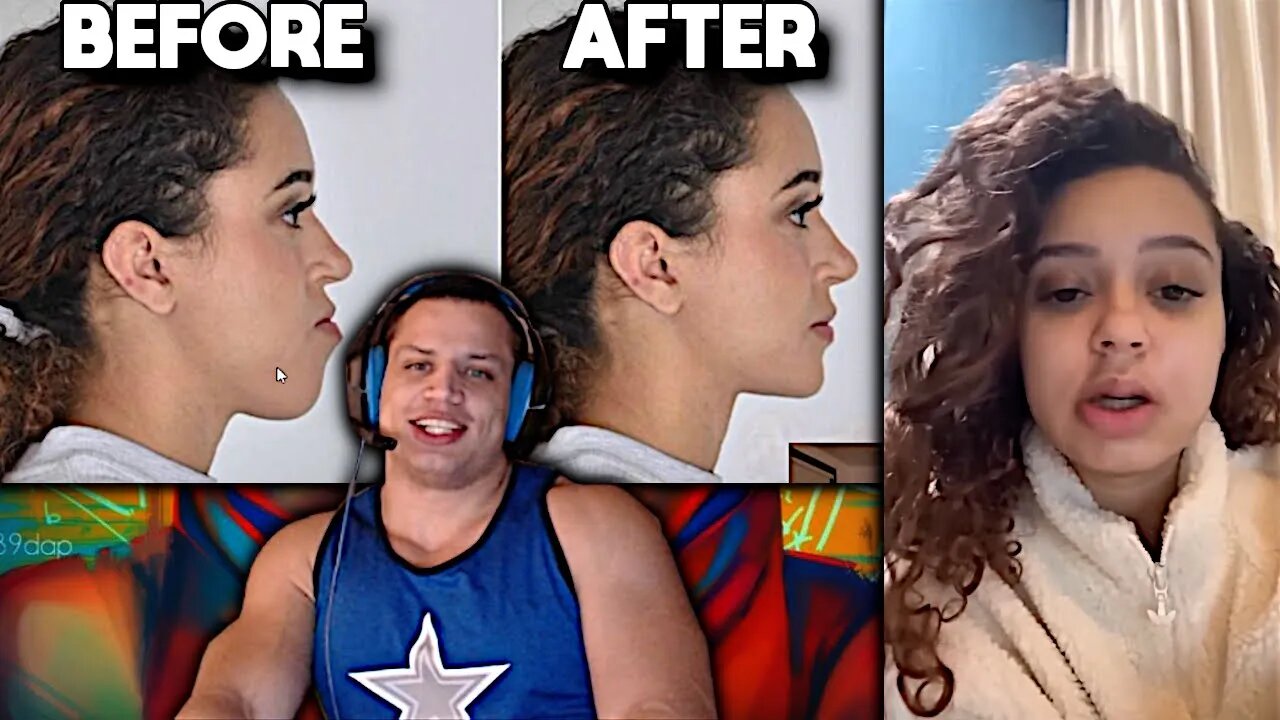 Tyler1 Macaiyla After Jaw Surgery