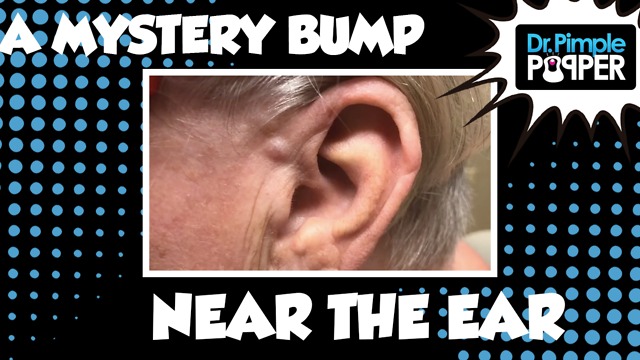 A Mystery Bump Near The Ear