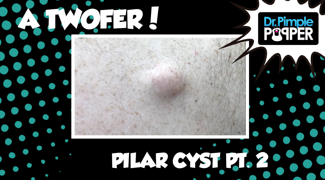 A Twofer: Part Two - Two Types of Cysts