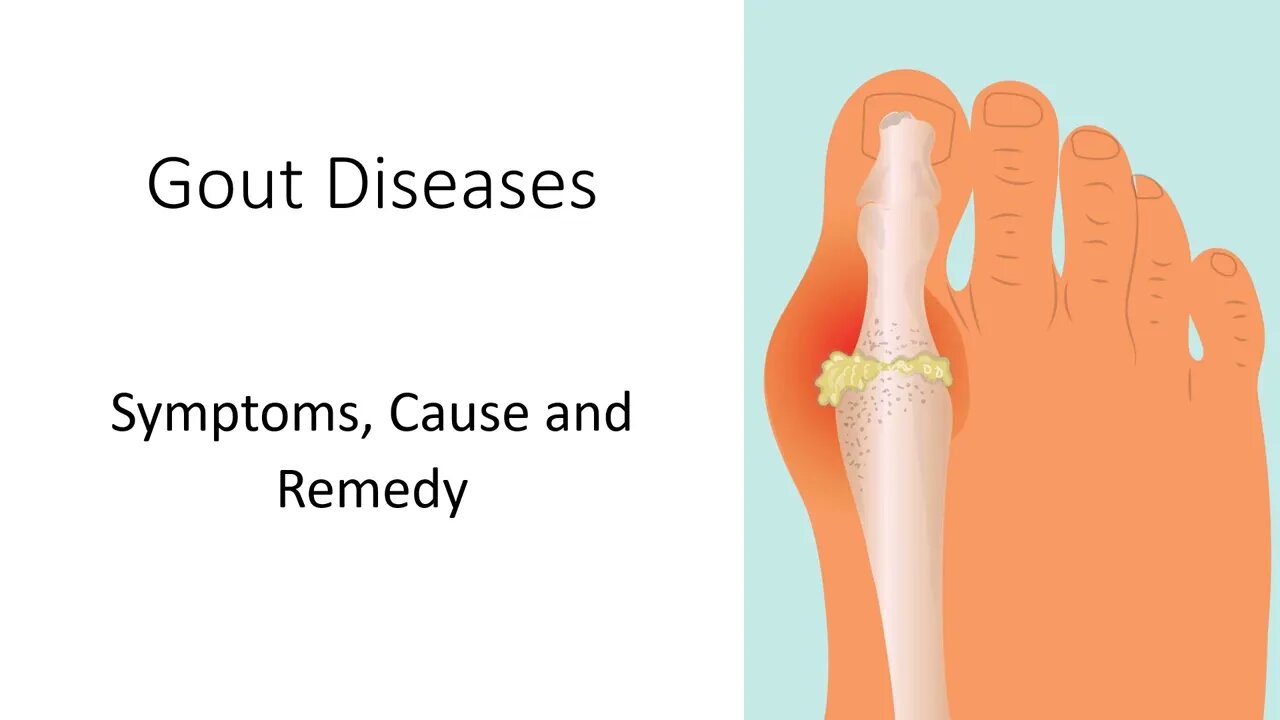 Gout Diseases | Symptoms, Cause and Remedy