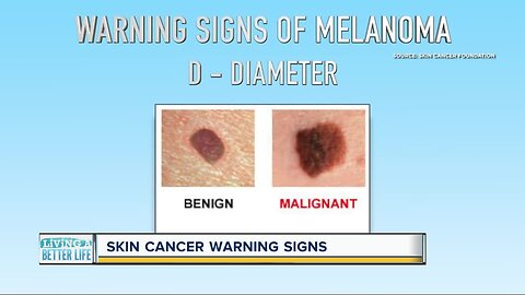 Can you spot skin cancer? Keep an eye out for these warning signs