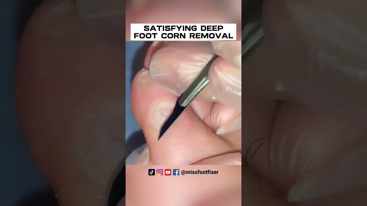 SATISFYING DEEP FOOT CORN REMOVAL BY MISS FOOT FIXER