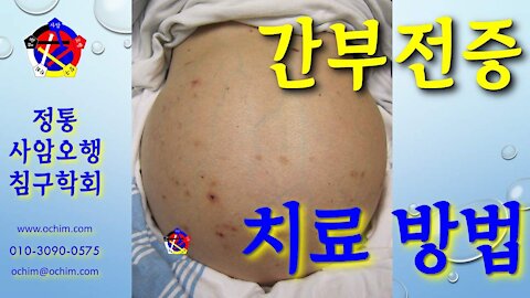 사암침, 사암침법 - 간부전증 치료 방법 - 비과학적 양의학 142