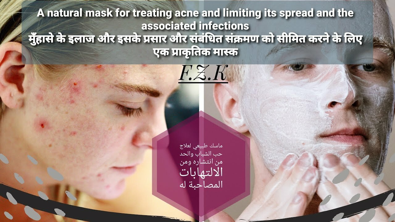 A natural mask to treat acne & melasma & get rid of them permanently & reduce their spread