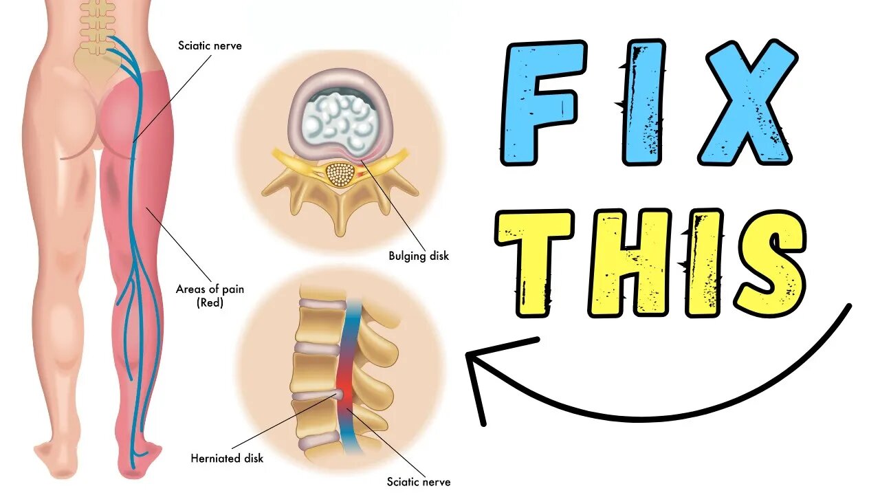 How To fix disc bulges while working in the office