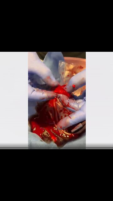 [VAX GENOCIDE] This video was taken by a heart surgeon on a 40 year old vaccinated athlete.