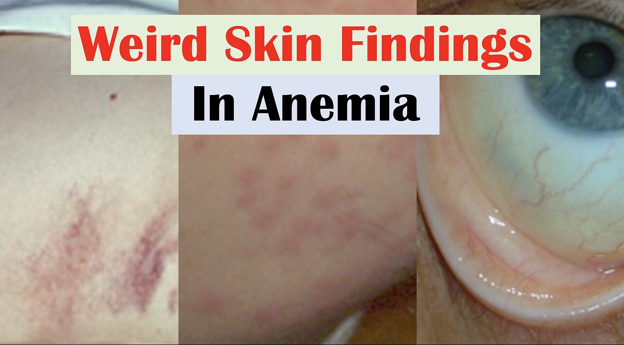 Anemia and Skin Findings (along with Nail Changes and Mouth Sores)