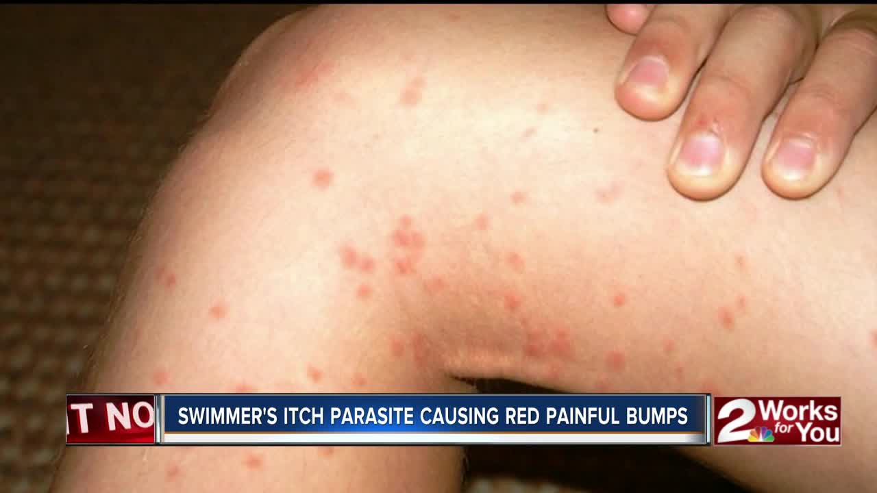 HN2U: Swimmer's itch parasite causing red painful bumps