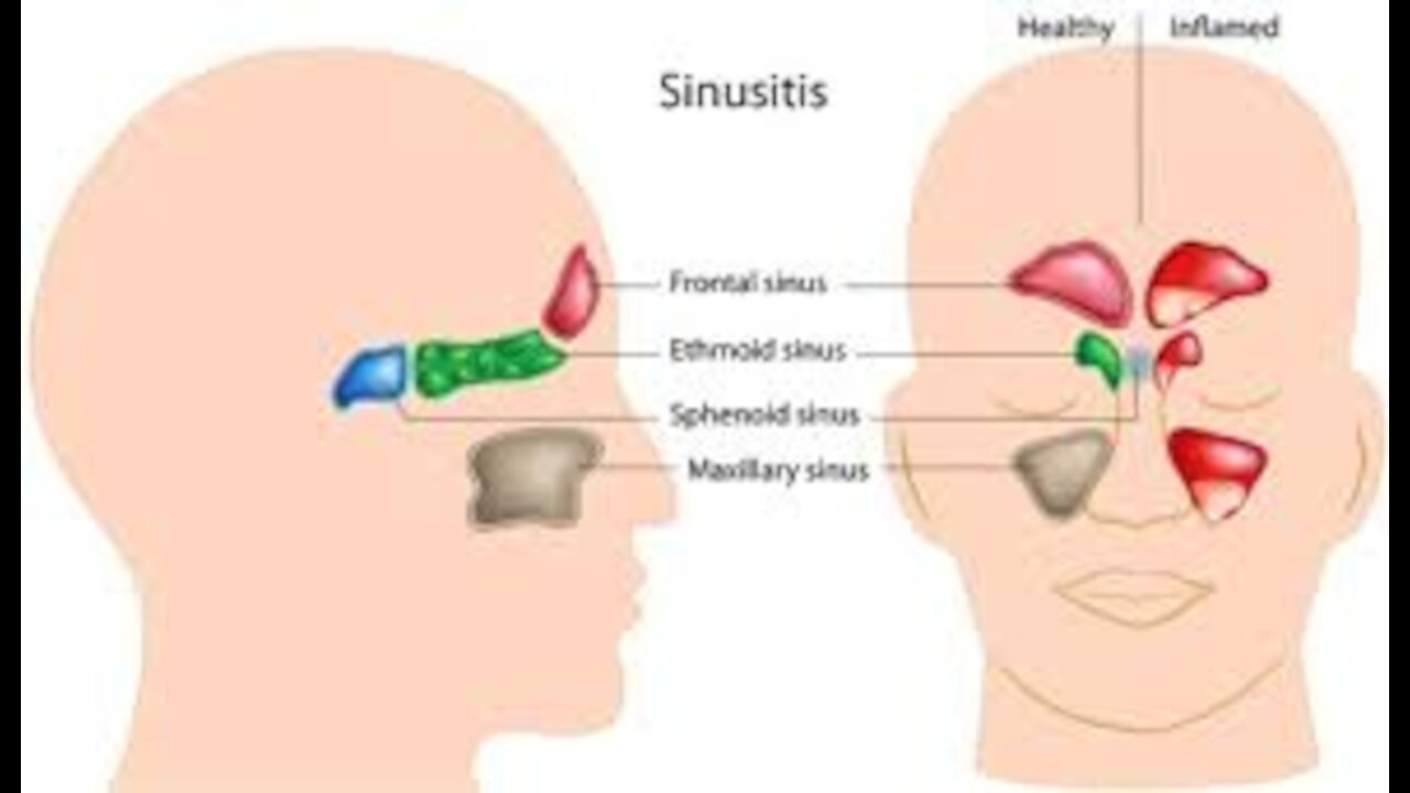 Sinus treatment