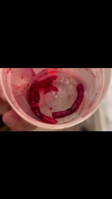 Matthew Erickson shows the blockages removed from his leg during emergency surgery, courtesy of J&J