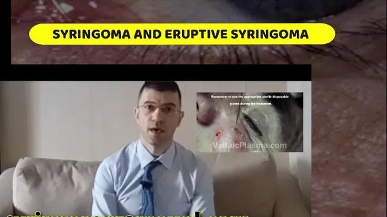 SYRINGOMA AND ERUPTIVE SYRINGOMA