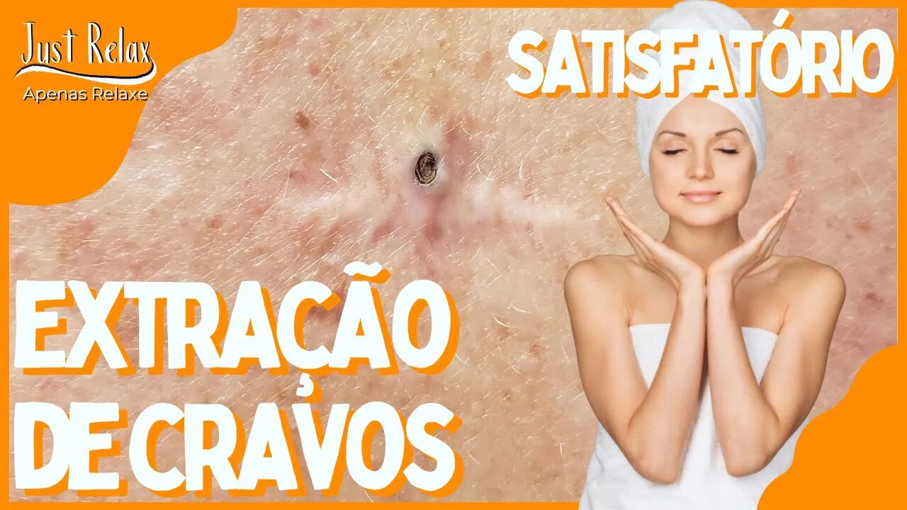 Só Relaxe Remoção de Cravos - Remove Blackheads and Pimples - Just Relax | Apenas Relaxe