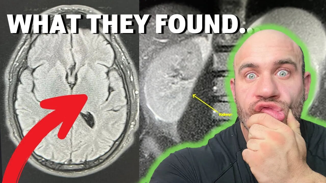 I DID A WHOLE BODY MRI SCAN