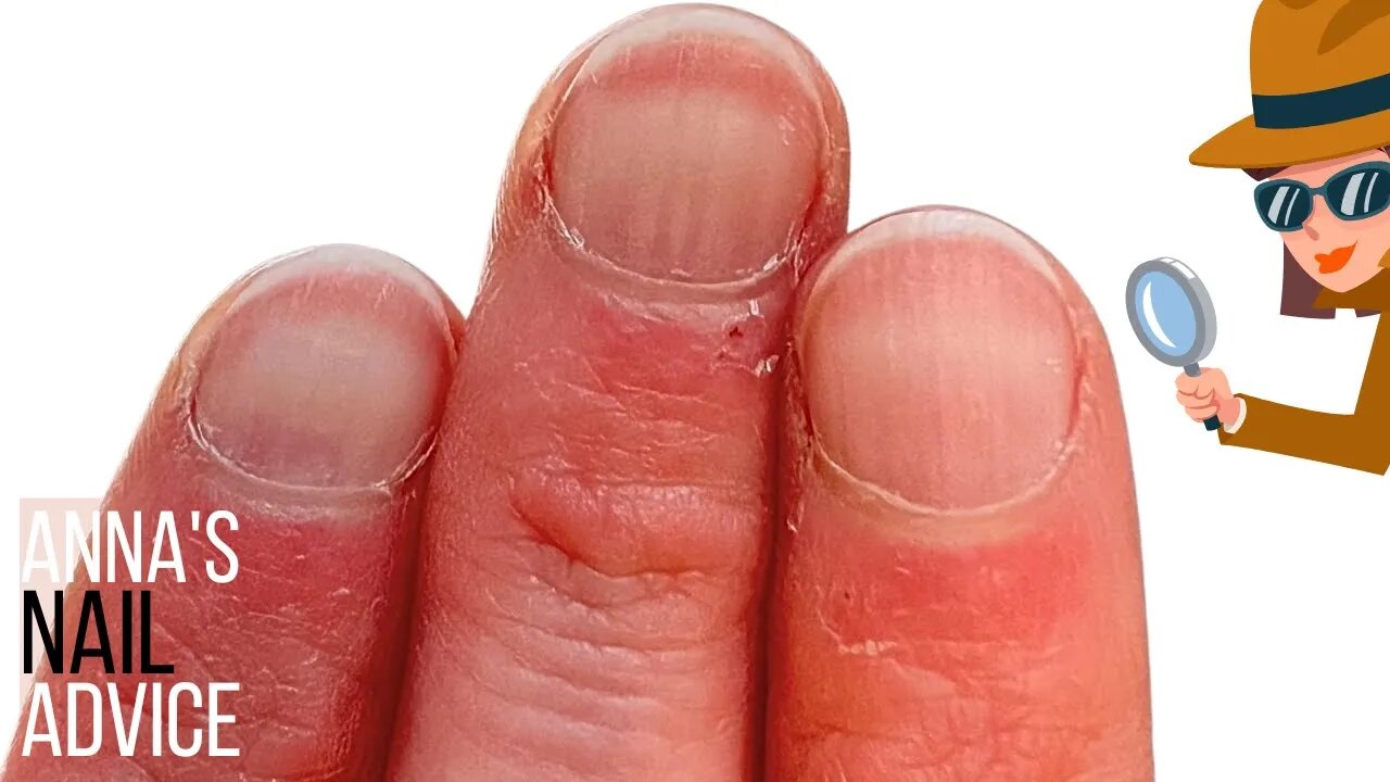 Getting impatient with THIS SKIN around the nails?