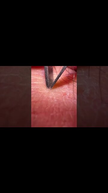 Zoomed & Precise Ingrown Hair Removal
