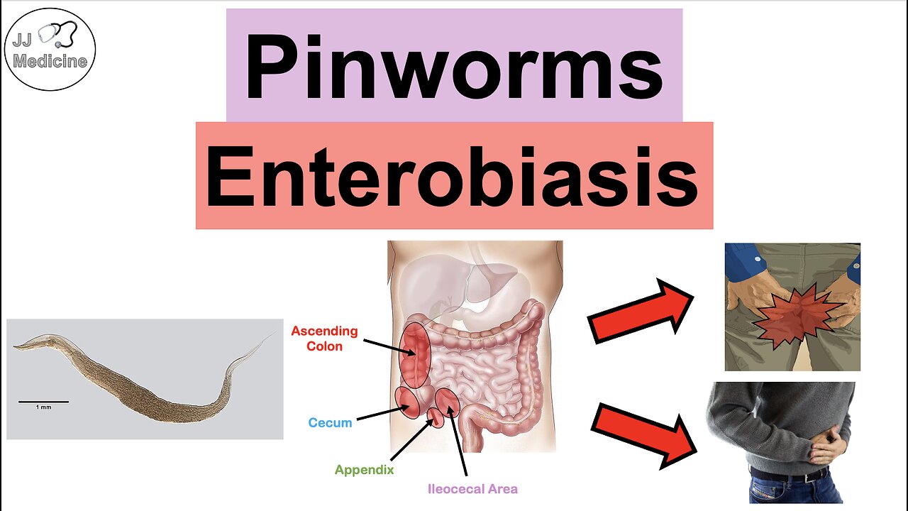 Pinworms (Enterobiasis) | Infection, Transmission, Symptoms, Diagnosis, Treatment