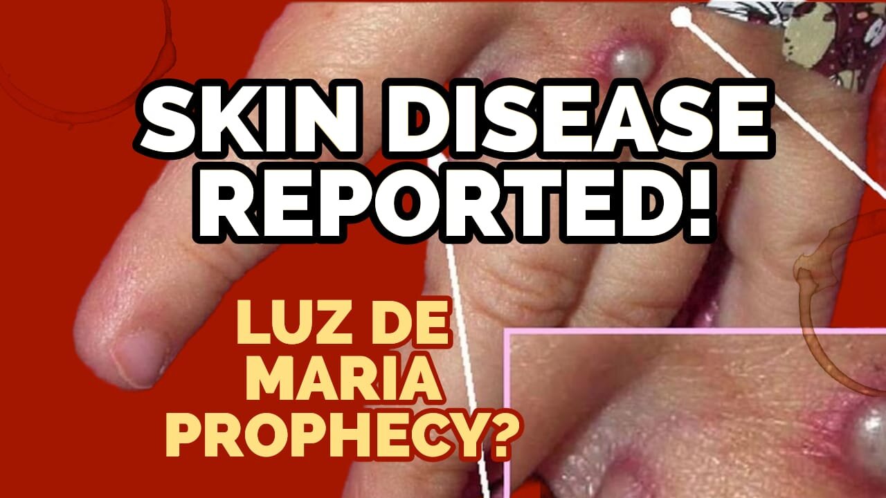 Developing: Outbreak Of Disturbing skin Disease Reported In UK