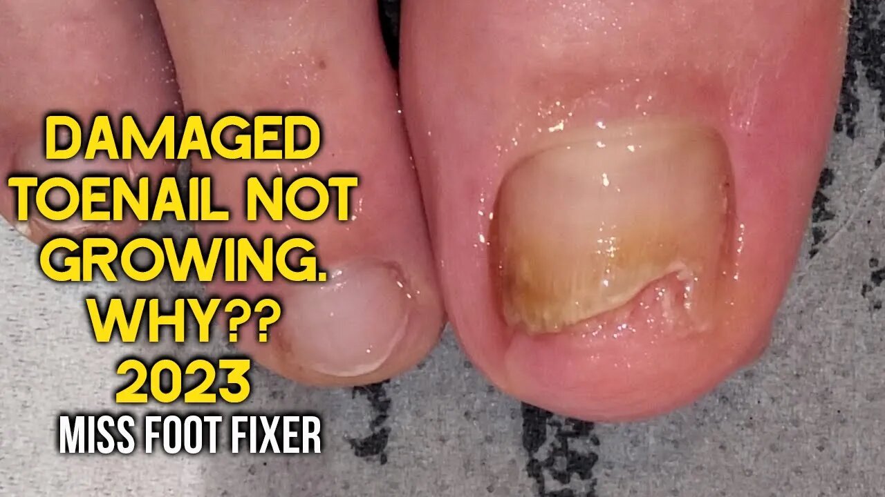 WHY ??? DAMAGED TOENAIL NOT GROWING 👣 IS IT NAIL FUNGUS??? 👣 FULL TREATMENT BY MISS FOOT FIXER