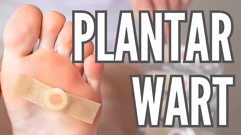 Plantar Wart - Pastor Thomas C Terry III