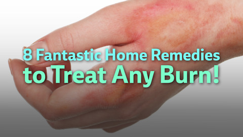 Home Remedies for Burns