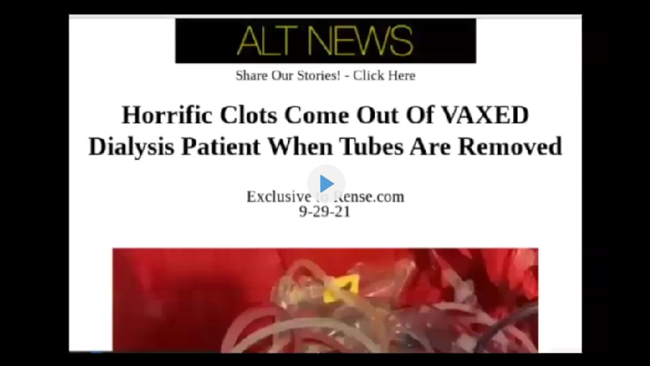 Horrific Blood Clots Come Out of VAXXED Dialysis Patient When Tubes Are Removed