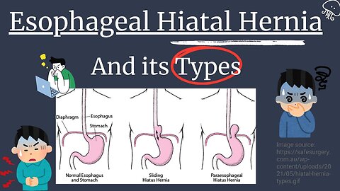 Esophageal Hiatal Hernia & Its Types | Sliding Hernia & Rolling Hernia Explained | Novice Medic