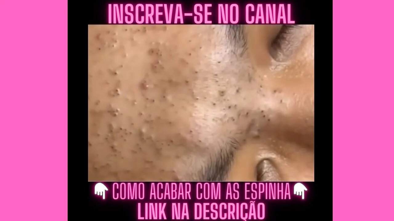 Espremendo cravos pretos na testa Espremendo Espinhas e Cravos