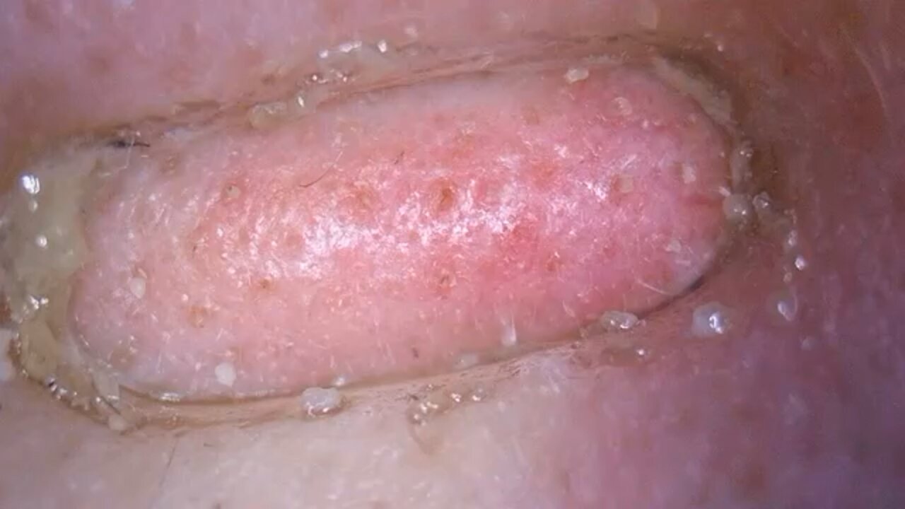 Pore Vacuum on My Face Follow Me